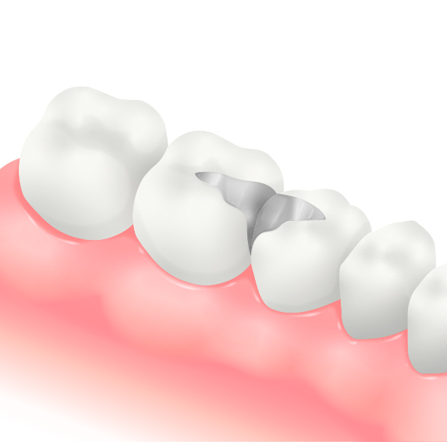 メタルインレー(銀色の金属)