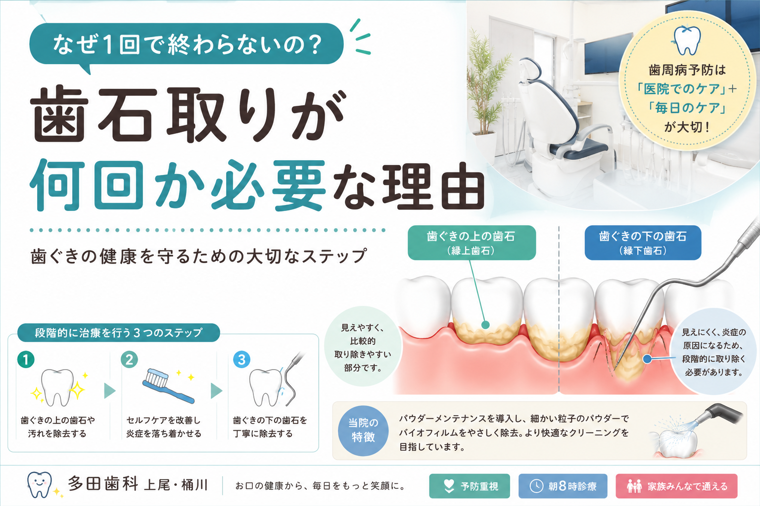 歯石取りはなぜ何回か通院が必要なの？歯周病治療について解説